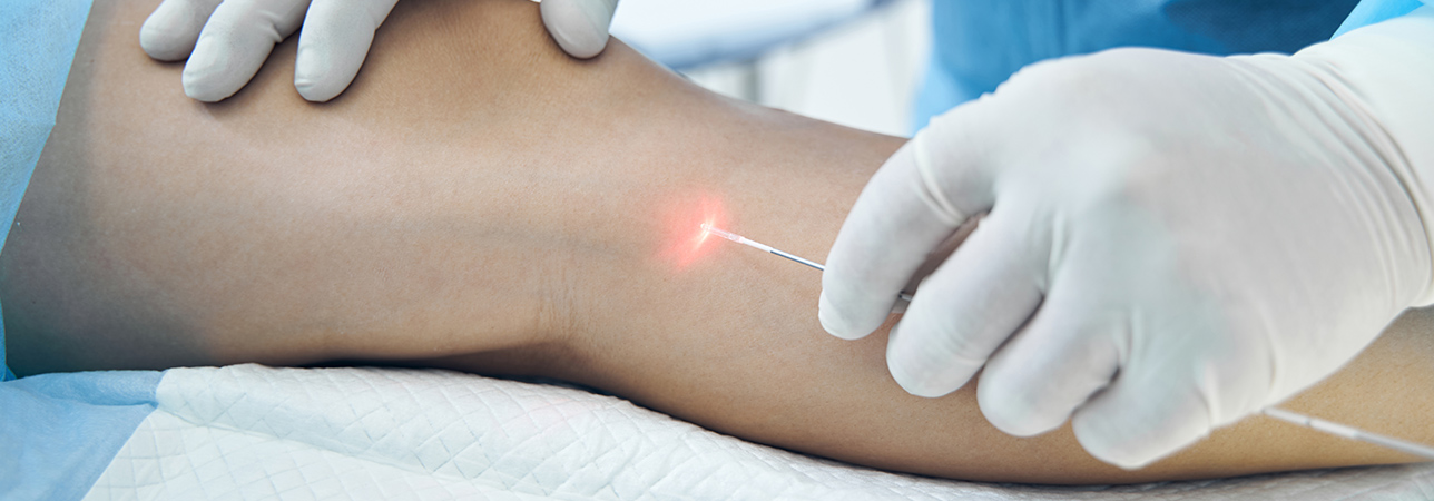 Laser wewnątrzżylny ELVeS. Pacjent w czasie zabiegu laserowego. Klinika flebologii.