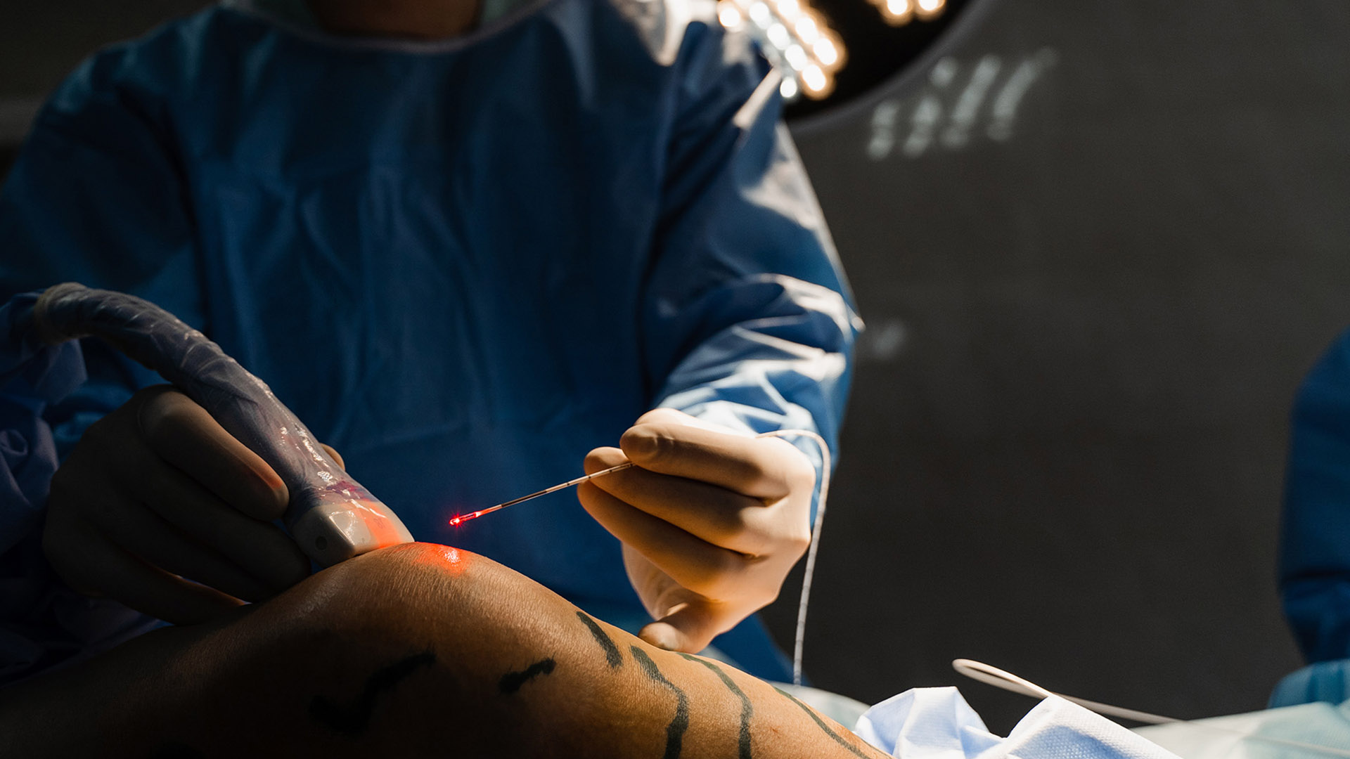 Żylaki kończyny dolnej leczone laserem EVLA.