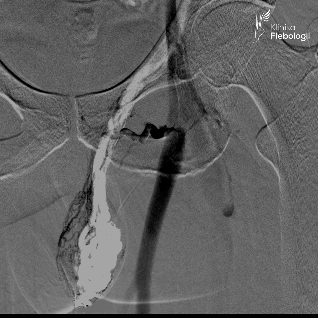 Żylaki powrózka nasiennego przed zabiegiem embolizacji żylnej.