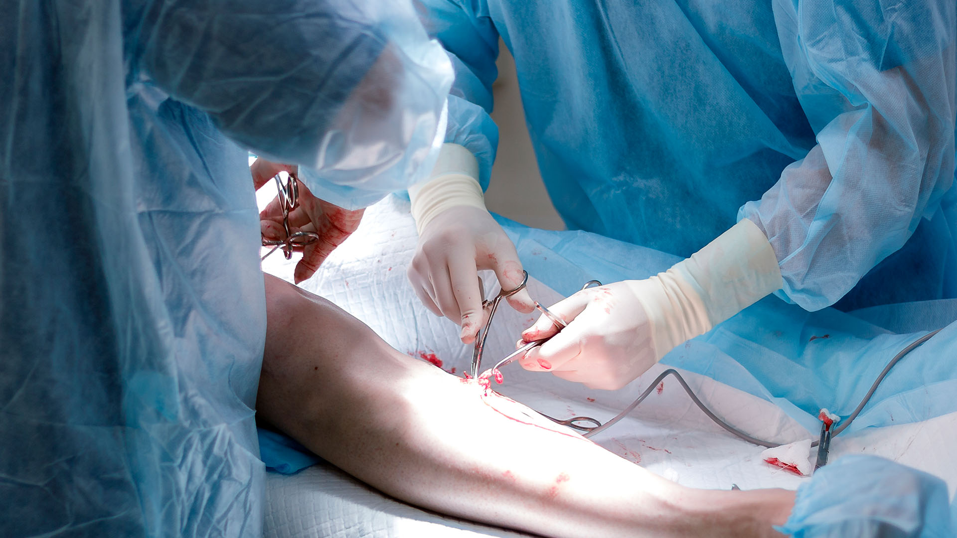 Chirurgia żył. Leczenie operacyjne żylaków.