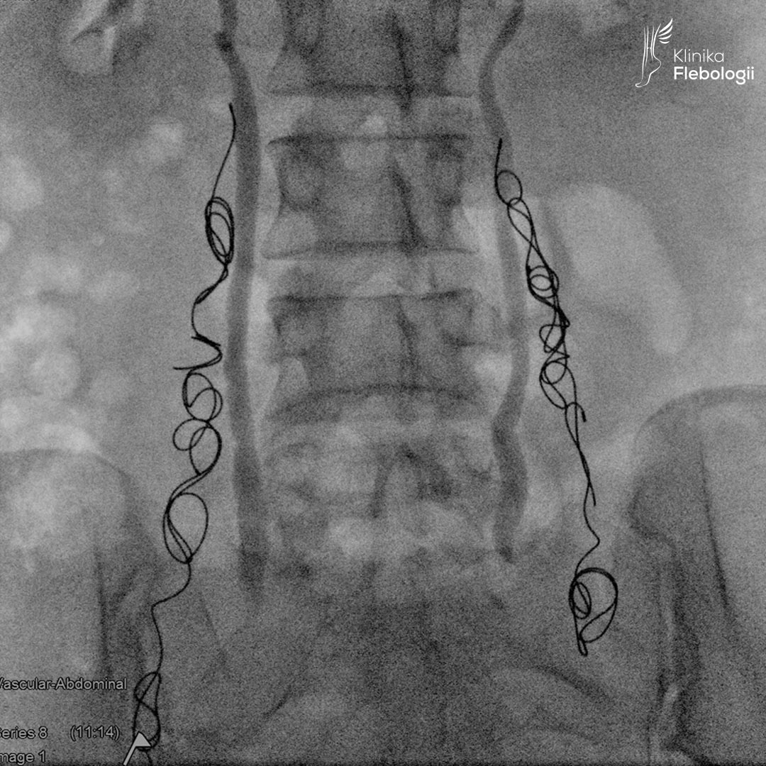 Stan po embolizacji żylnej 2-stronnej.