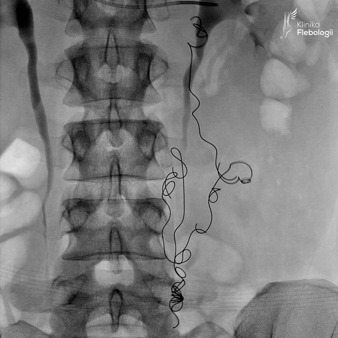 Stan po embolizacji żyły jajnikowej i krążenia obocznego.