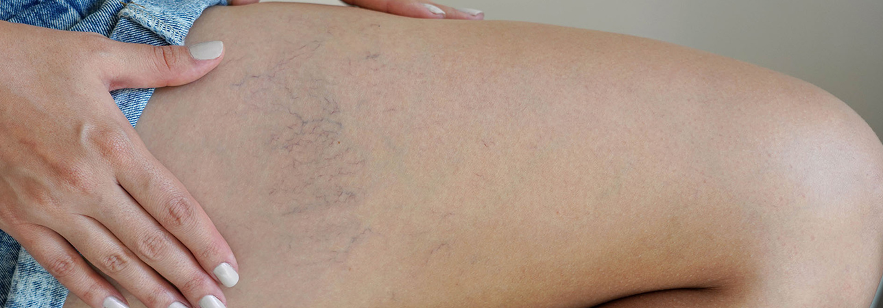 Pajączki naczyniowe na udzie.