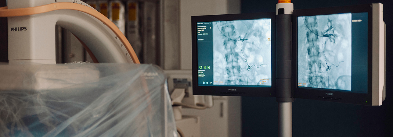 Zabieg embolizacji żylnej wykonywany w Pracowni Naczyniowej Kliniki Flebologii.