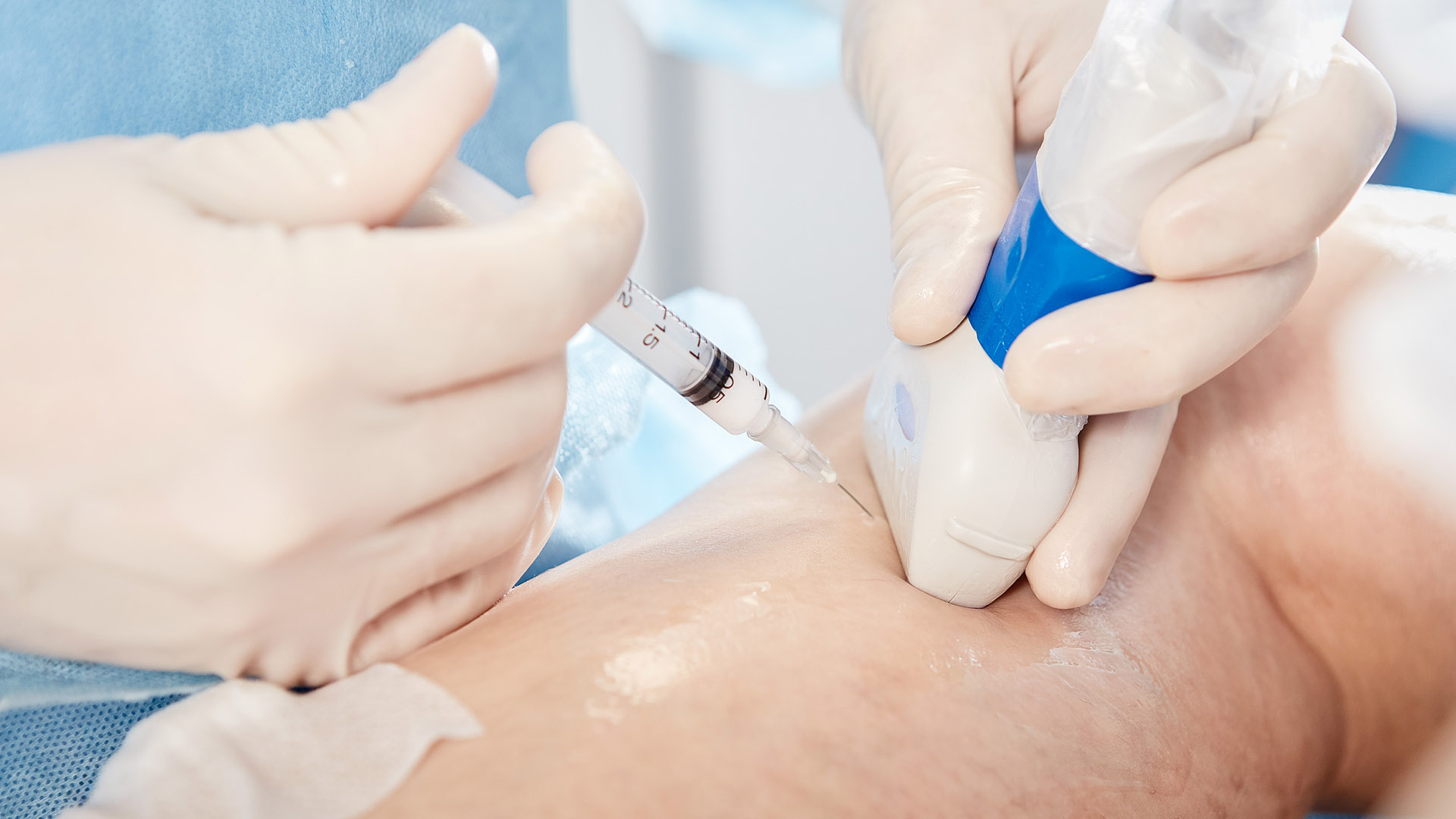 Flebolog wykonuje skleroterapię pod kontrolą USG. W strzykawce spieniony sklerozant.