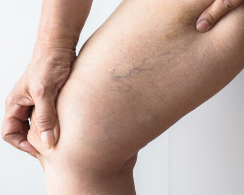 Pajączki naczyniowe na nodze.