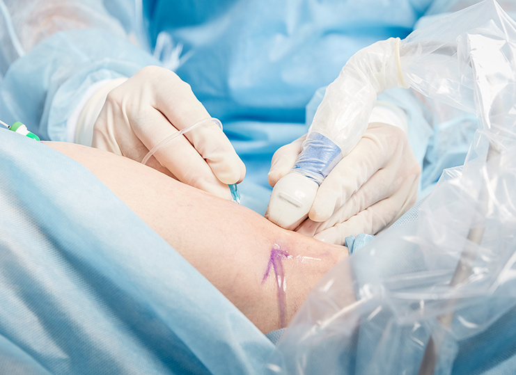 Zabieg laserowy ELVeS 1470. Klinika Flebologii