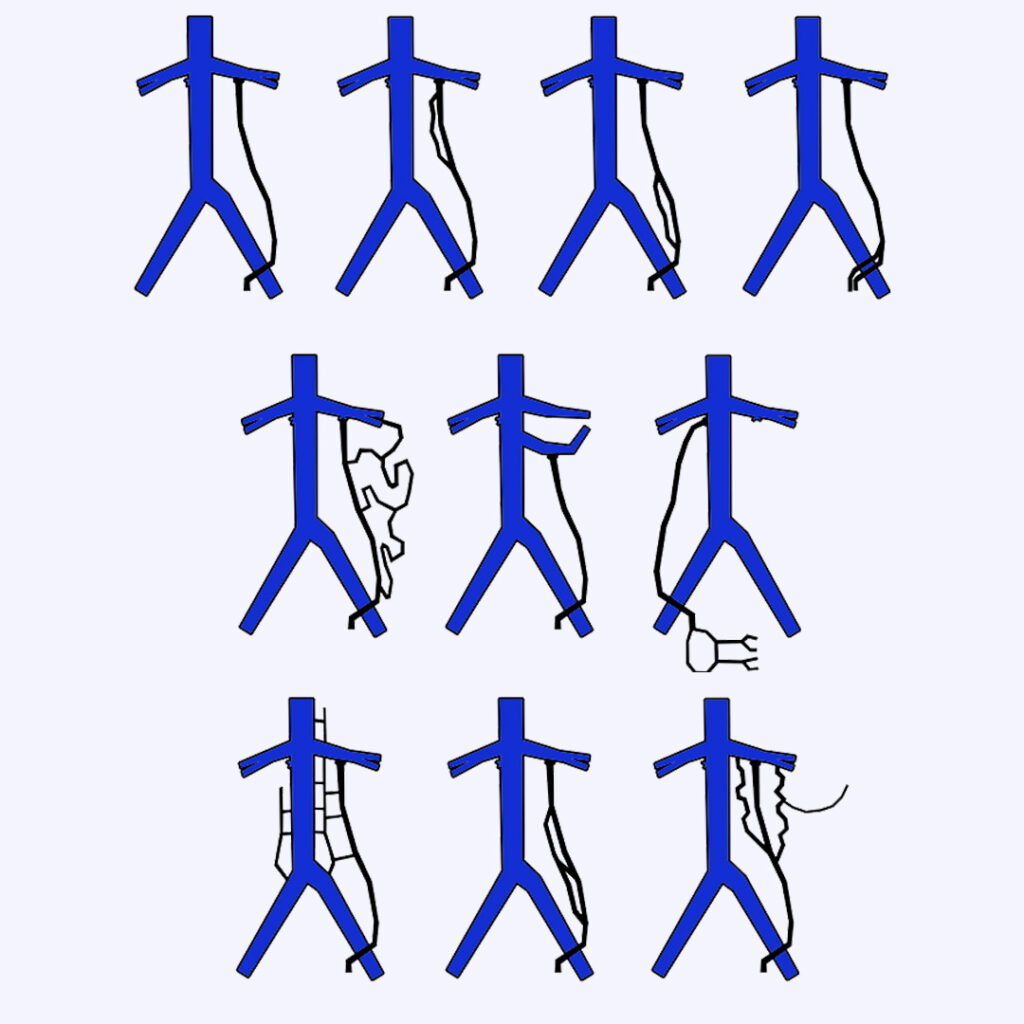 Typy anatomiczne warunkujące niewydolność lewej żyły jądrowej i powstawanie żylaków powrózka nasiennego.