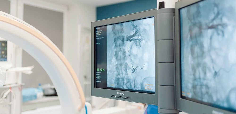 Embolizacja żylna lewej żyły jajnikowej. Klinika Flebologii.