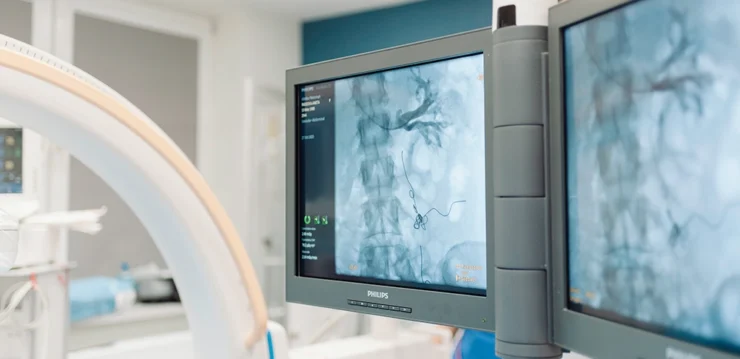 Embolizacja żylna lewej żyły jajnikowej. Klinika Flebologii.