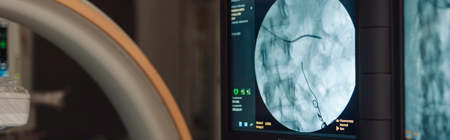 Embolizacja żylna z wenoplastyką lewej żyły nerkowej. Klinika Flebologii