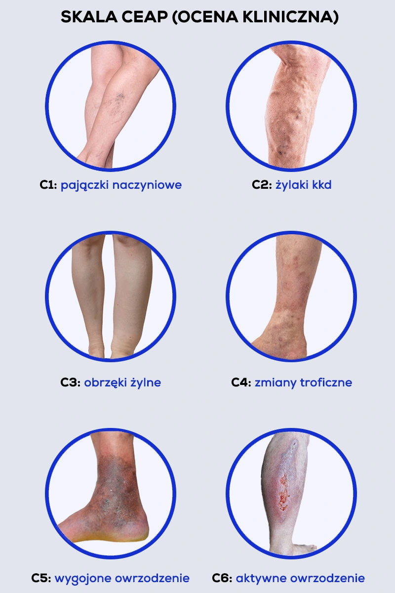 Skala CEAP – klasyfikacja kliniczna przewlekłej choroby żylnej, pokazująca różne stadia zaawansowania: C1 – pajączki naczyniowe, C2 – żylaki kończyn dolnych, C3 – obrzęki żylne, C4 – zmiany troficzne, C5 – wygojone owrzodzenie, C6 – aktywne owrzodzenie. Copyright Klinika Flebologii.