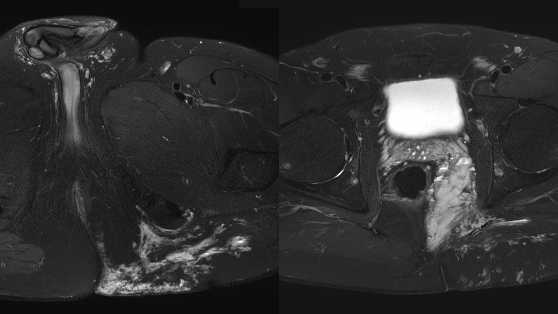 Malformacja żylna w okolicy miednicy, pośladka i krocza – obraz z rezonansu magnetycznego (MR) przedstawiający szczegóły zmian naczyniowych. Zaawansowana diagnostyka malformacji żylnych w Klinice Flebologii.