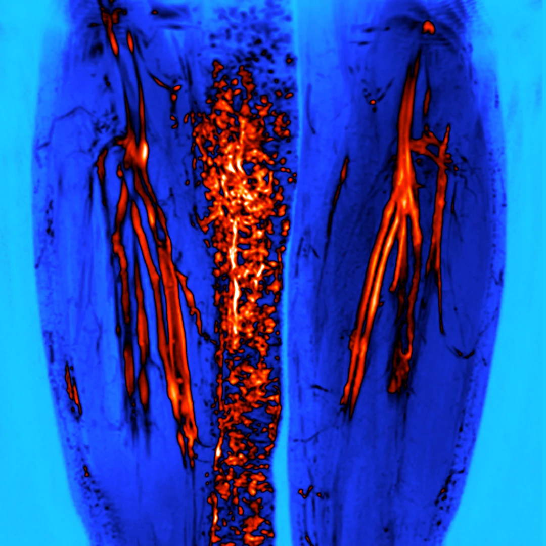 Złożona malformacja żylna – obraz z wenografii MR przedstawiający anomalię naczyń krwionośnych kończyn dolnych. Diagnostyka malformacji żylnych za pomocą rezonansu magnetycznego w Klinice Flebologii.
