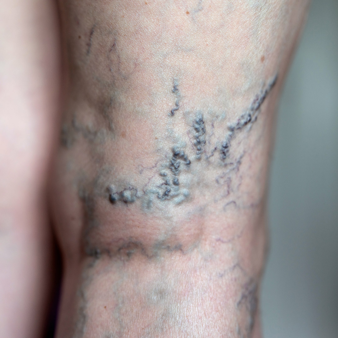 Malformacja żylna. Venulektazje.