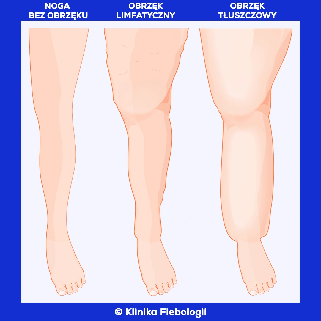 Klinika Flebologii prezentuje trzy ilustracje przedstawiające nogi od kolan w dół, obrazujące rodzaje obrzęków kończyn dolnych:
* Noga bez obrzęku: zdrowa.
* Obrzęk limfatyczny: noga z widocznym obrzękiem, skóra napięta i błyszcząca, bez wyraźnego zarysu kostek.
* Obrzęk tłuszczowy: noga z nadmierną ilością tkanki tłuszczowej, o zmienionym kształcie, z widocznymi fałdami skóry.
