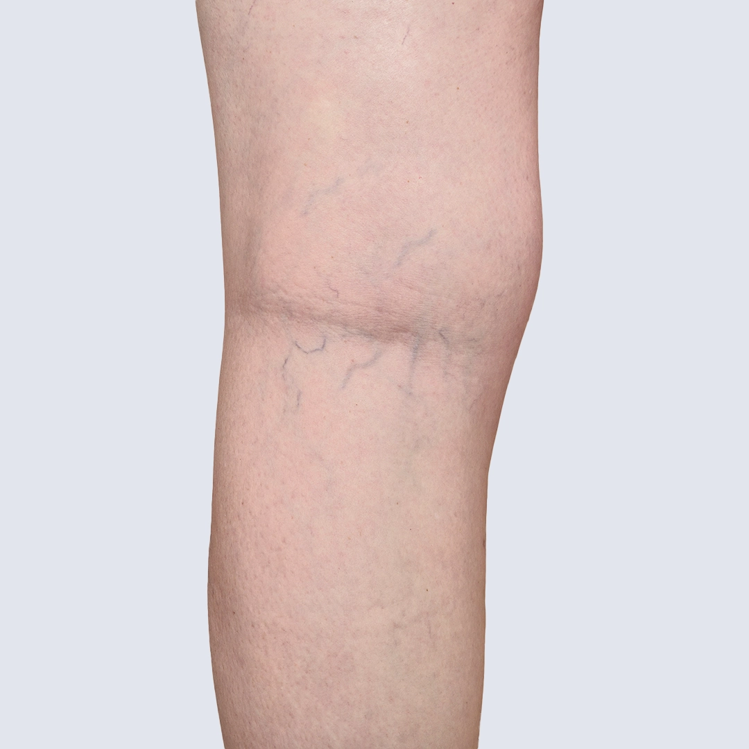 Podudzie z widocznymi pajączkami przed zabiegiem skleroterapii – niewydolność żylna z poszerzonymi żyłami. Obraz przed leczeniem w Klinice Flebologii