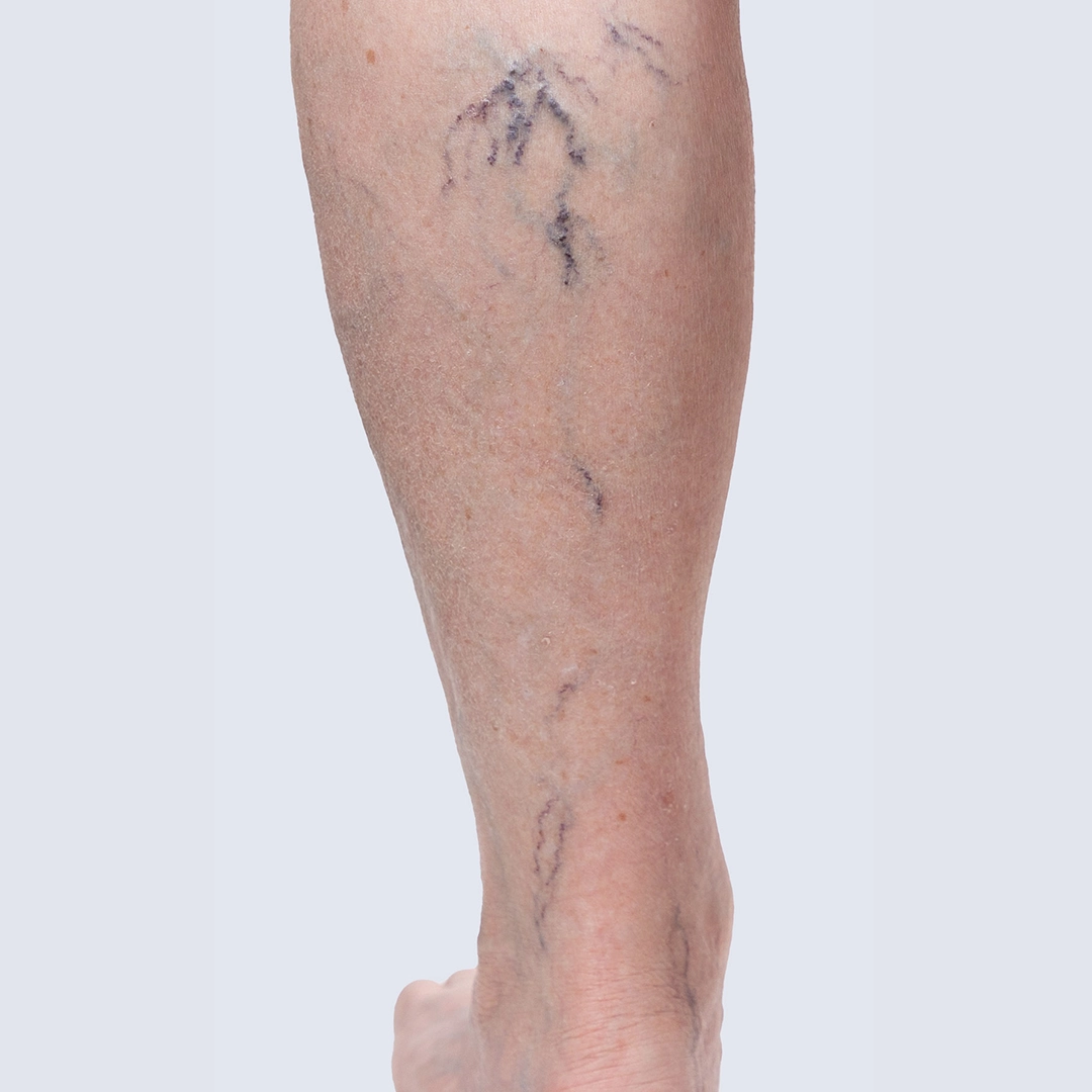 Podudzie z widocznymi żylakami przed zabiegiem – zaawansowana niewydolność żylna z wyraźnie poszerzonymi żyłami. Obraz przed leczeniem w Klinice Flebologii