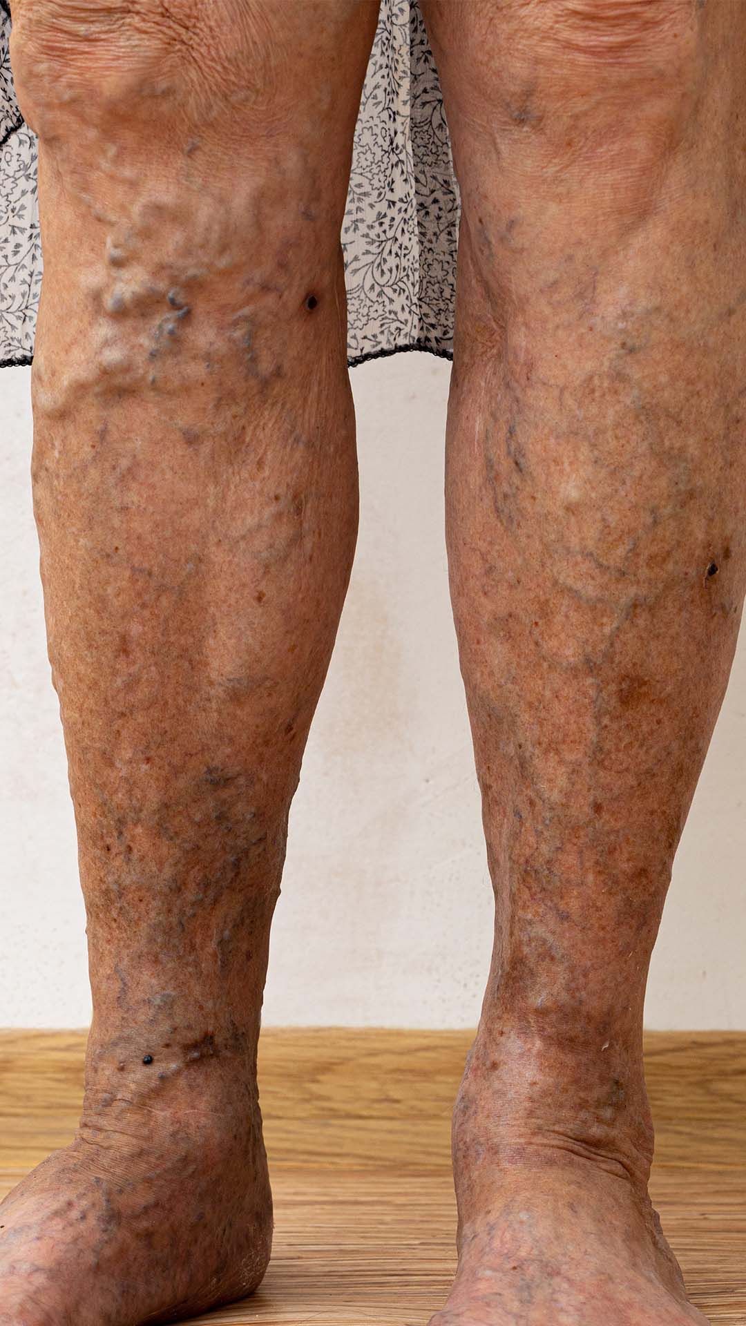 Żylaki kończyn dolnych o osoby starszej. Przewlekła choroba żylna.