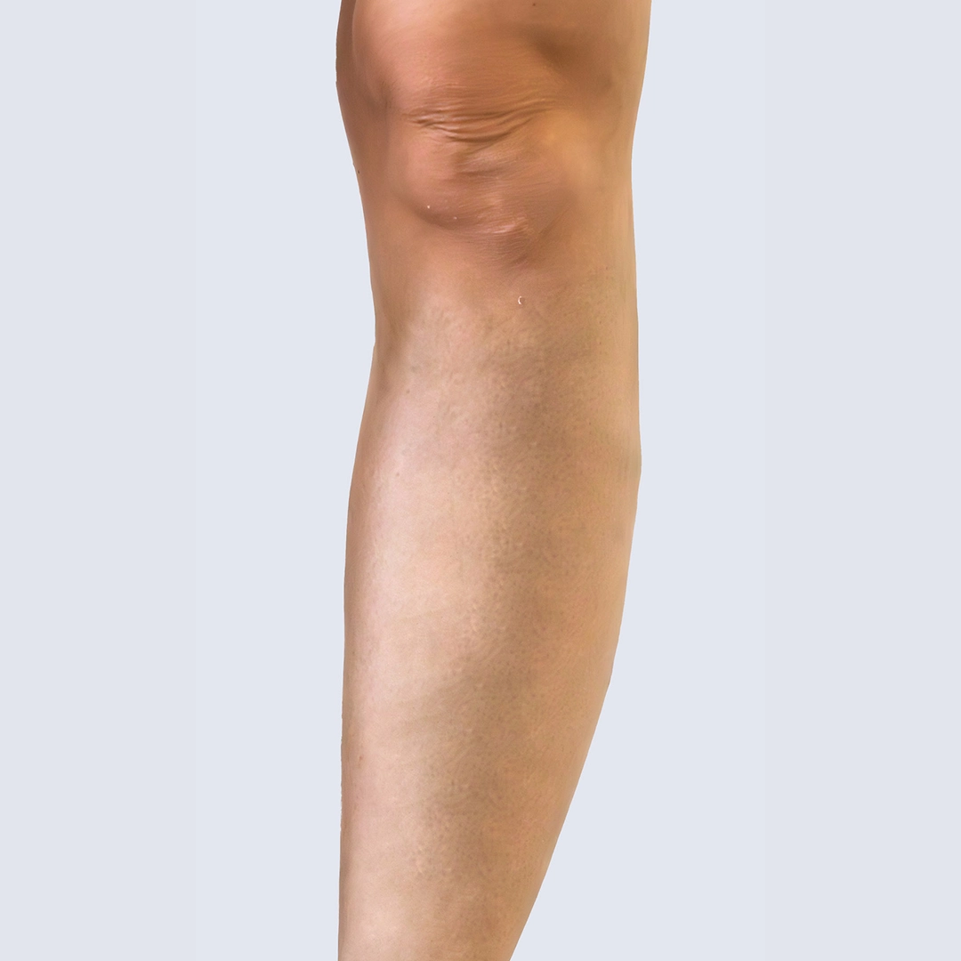 Podudzie po zabiegu usunięcia żylaków – gładka skóra bez widocznych objawów niewydolności żylnej. Efekt leczenia żylaków w Klinice Flebologii.