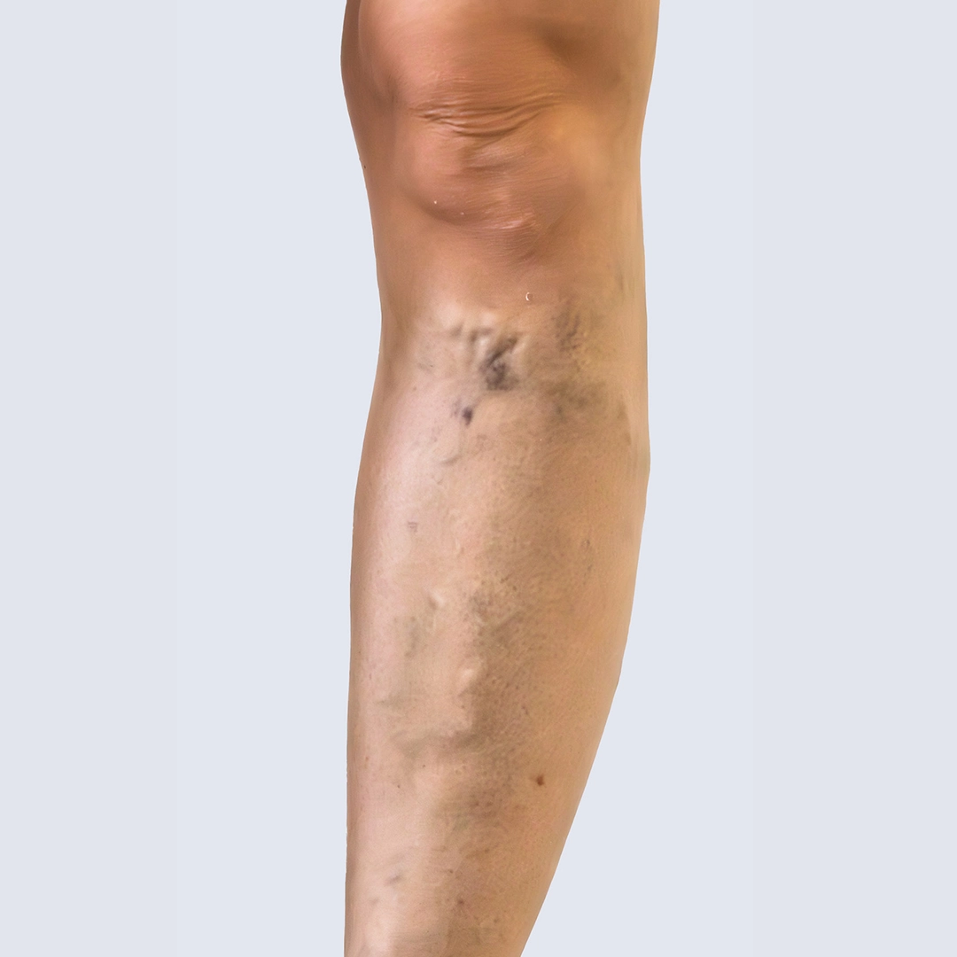 Żylaki na podudziu przed zabiegiem – widoczna zaawansowana niewydolność żylna objawiająca się wyraźnie poszerzonymi żyłami. Diagnostyka i leczenie żylaków w Klinice Flebologii.