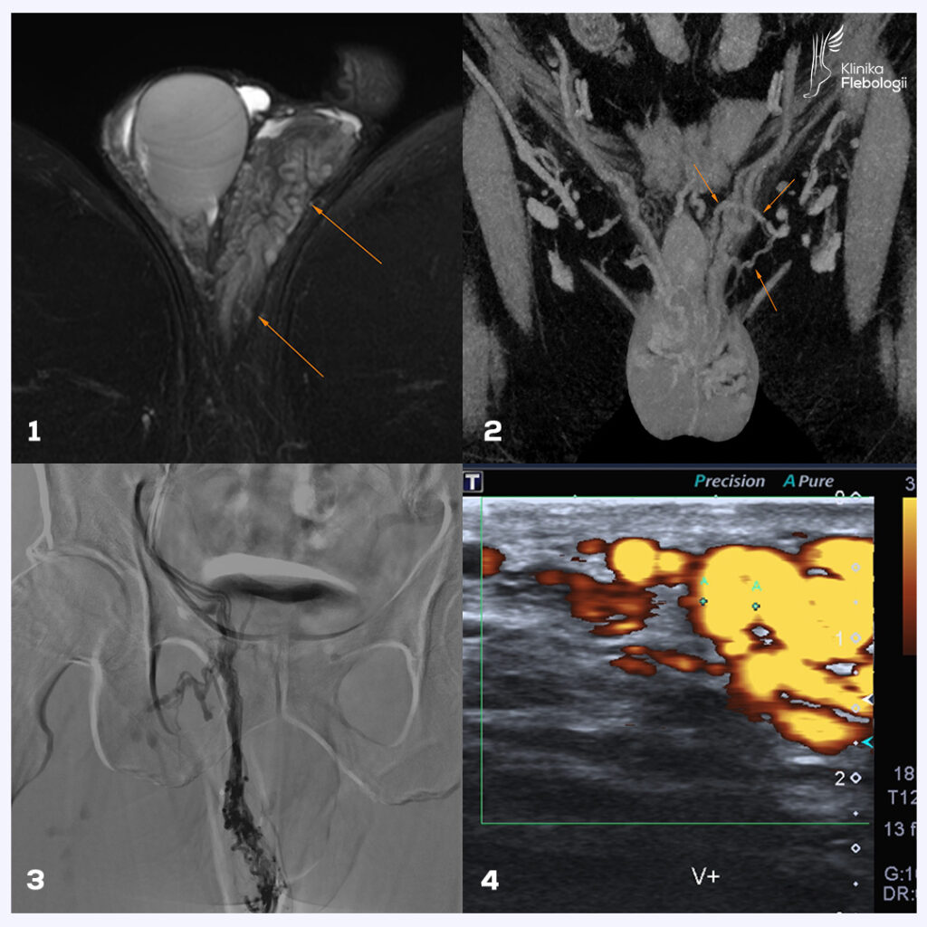 Badania diagnostyczne służące do oceny nmiewydolności żylnej miednicy typu męskie. Wenografia MR, wenografia TK, flebografia i USG Doppler.