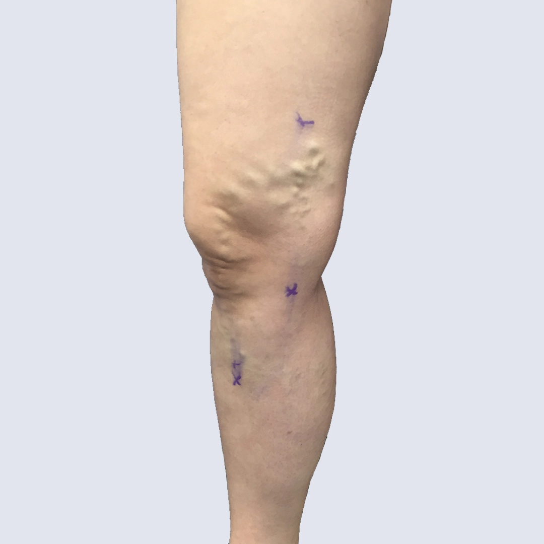 Noga z widocznymi żylakami i zaznaczonymi miejscami do zabiegu – zaawansowana niewydolność żylna z wyraźnym poszerzeniem żył. Obraz przed leczeniem w Klinice Flebologii.