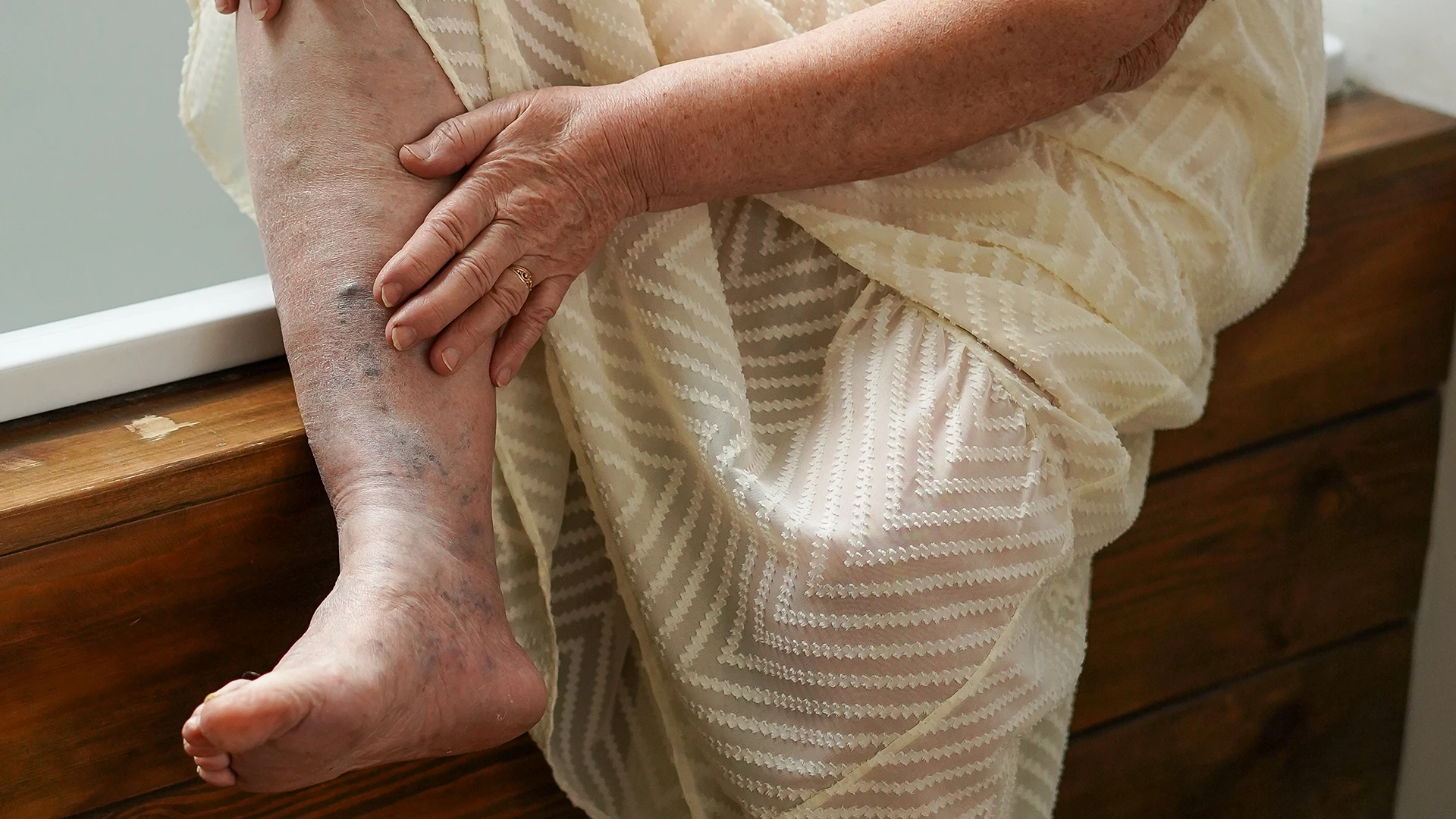 Żylaki na skórze nogi. Stan przedowrzodzeniowy. Kobieta.