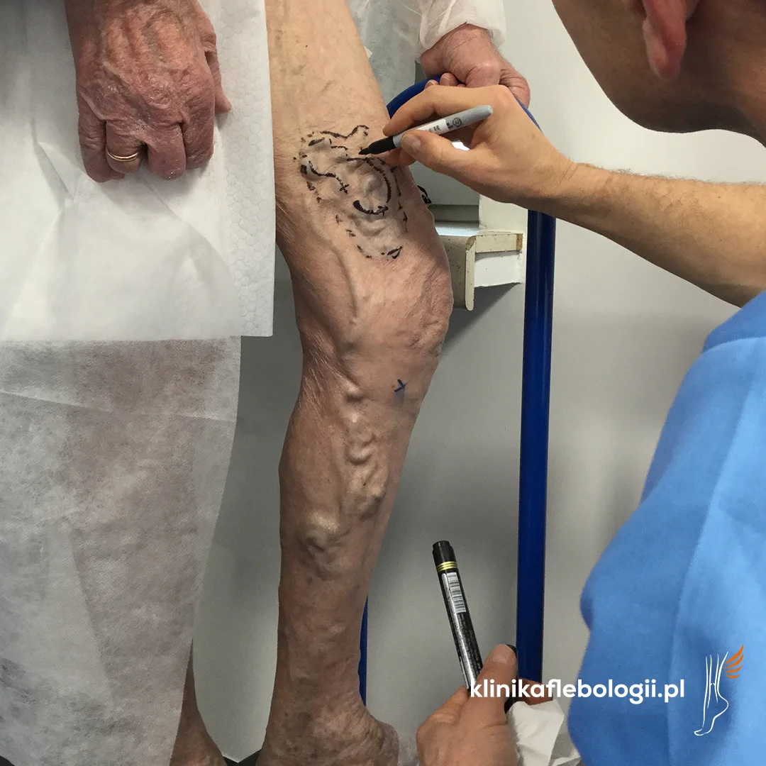Zabieg chirurgicznego leczenia żylaków w Klinice Flebologii. Mapowanie żył do flebektomii.