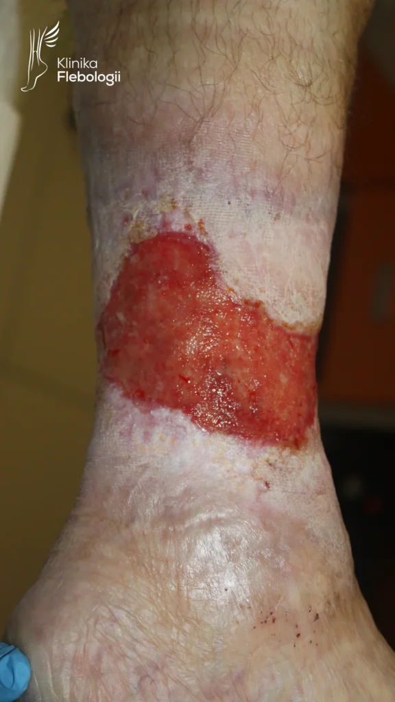 Podudzie lewe z owrzodzeniem żylnym goleni. Autorstwo dr Tomasz Grzela. Klinika Flebologii.
