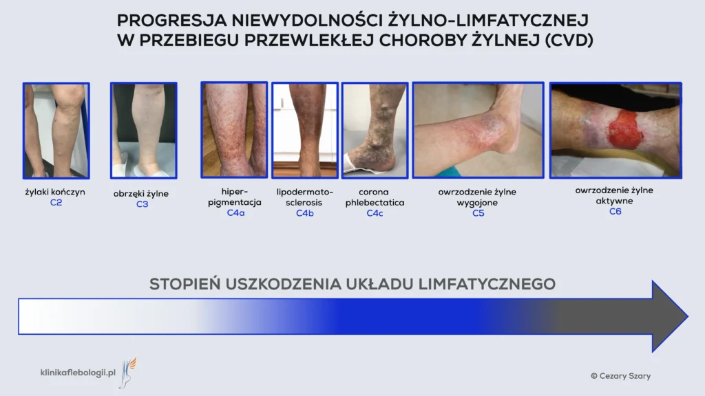 Schemat przedstawiający progresję niewydolności żylno-limfatycznej w przebiegu przewlekłej choroby żylnej (CVD). Infografika zawiera 7 zdjęć klinicznych uszeregowanych od lewej do prawej, pokazujących kolejne etapy rozwoju choroby według klasyfikacji CEAP. Autor: Cezary Szary