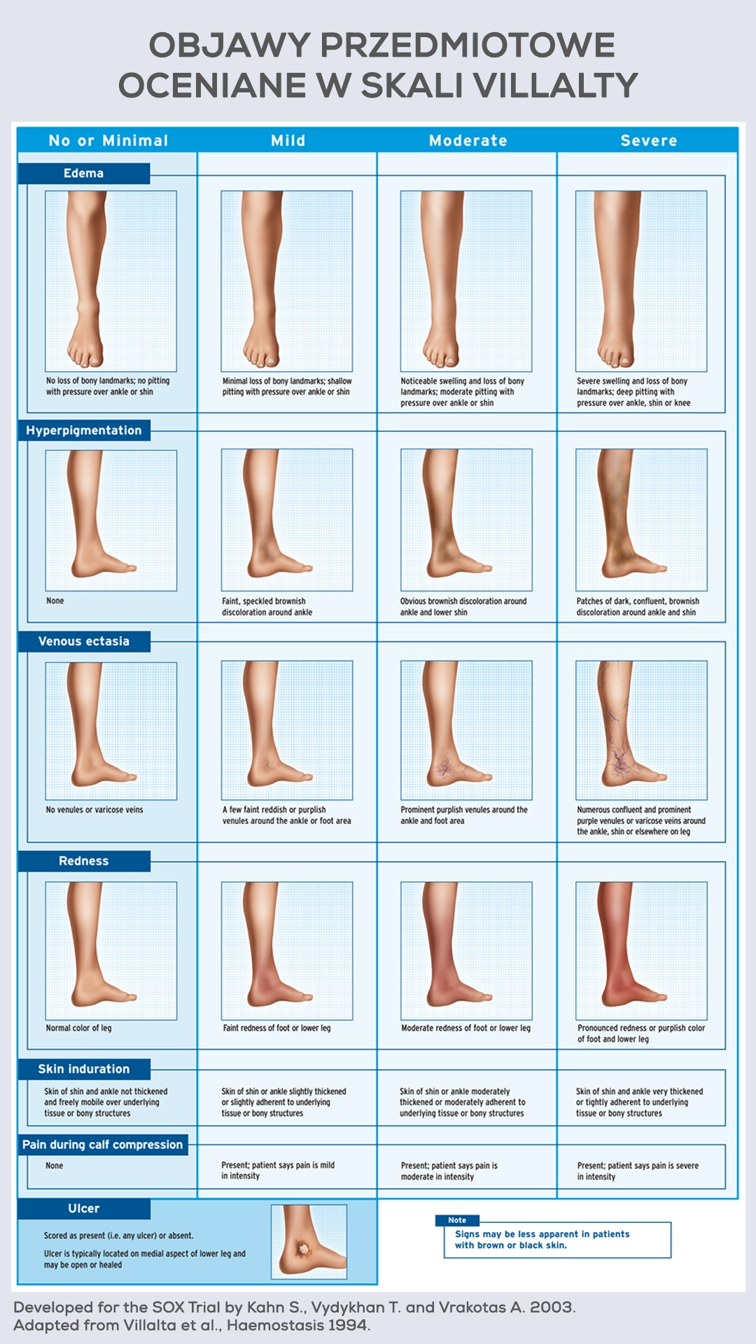 Skala Villalty. Zespół pozakrzepowy. Klinika Flebologii. 