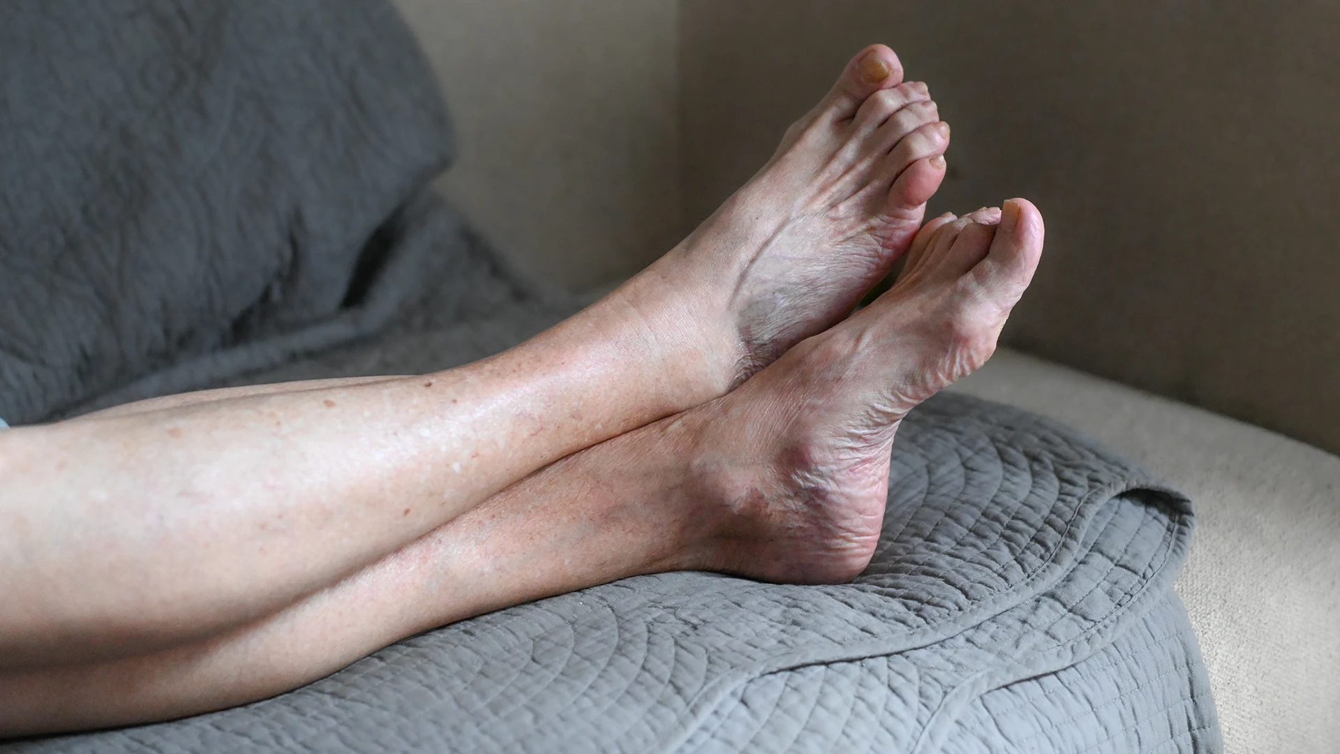 Zdjęcie nóg kobiety z widocznymi zmianami skórnymi na tle choroby żylnej.