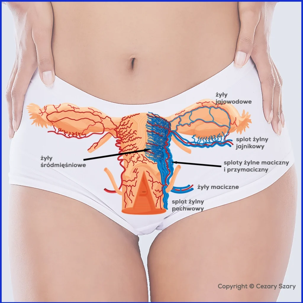 Żyły macicy i przydatków. Żylaki przymacicz. Schemat żył miednicy. Cezary Szary