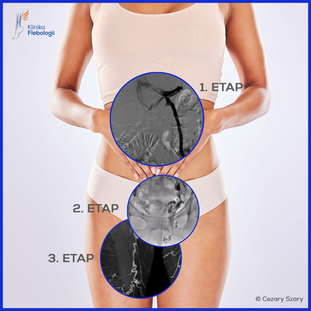 Schemat przyczynowego leczenia choroby żylnej podzielony na trzy etapy. Autorska strategia leczenia zespołu Kliniki Flebologii. 