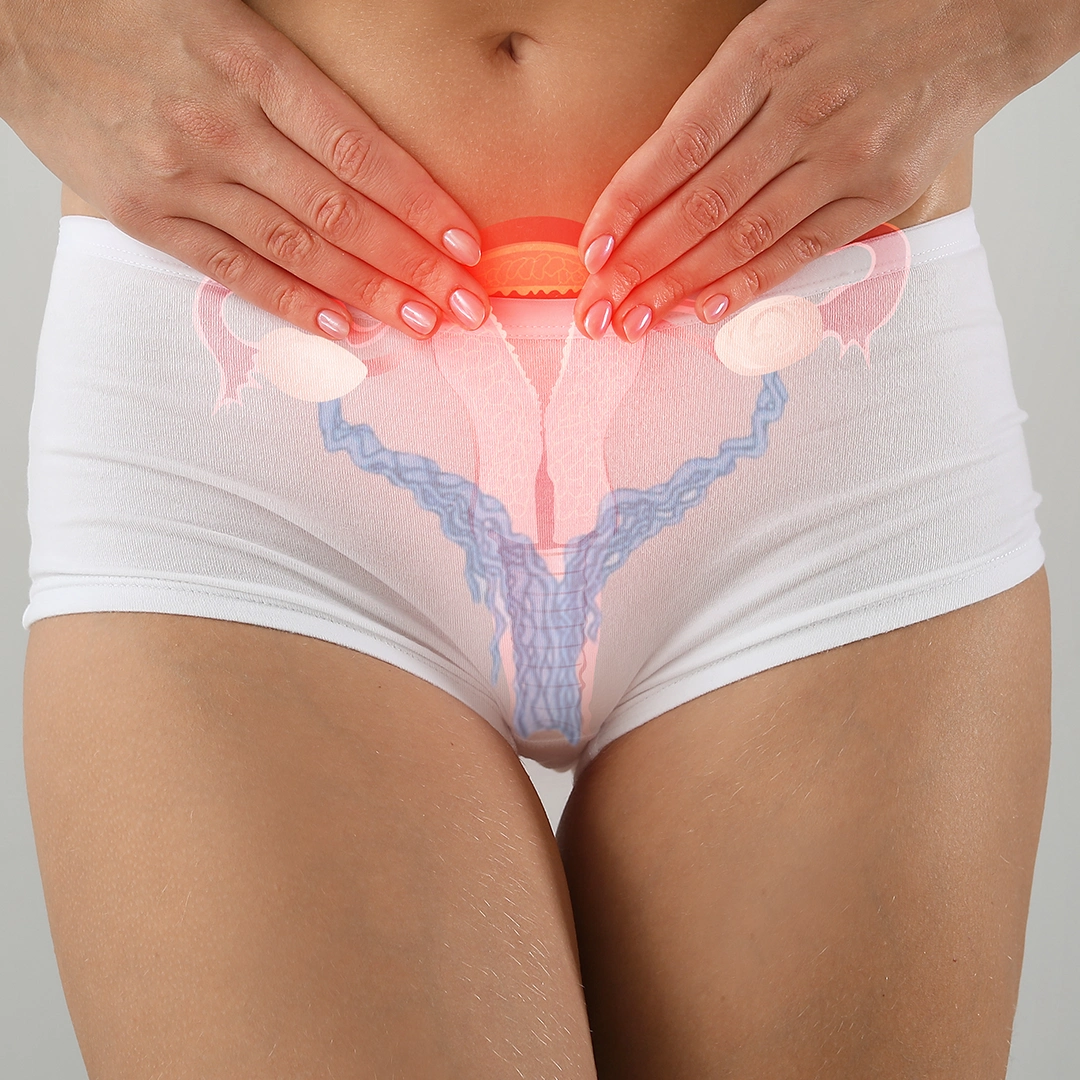 Żylaki pochwy. Schemat. Klinika Flebologii.