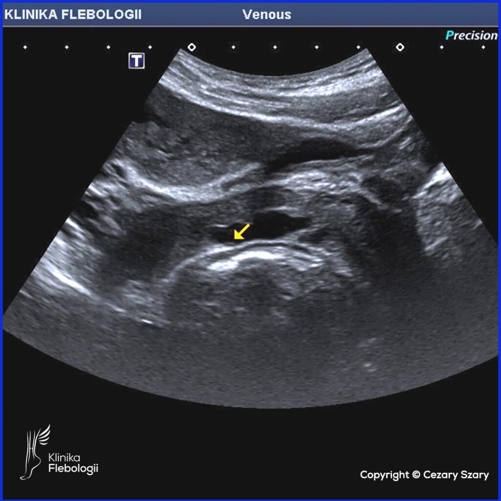 Duże żylaki tylnej ściany pochwy widoczne w badaniu USG Doppler żył jamy brzusznej i miednicy. 