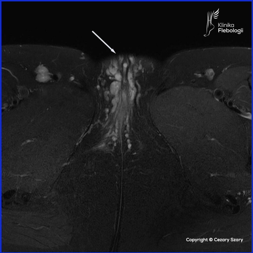 Żylaki sromu po ciąży. Wenografia MR. Klinika Flebologii