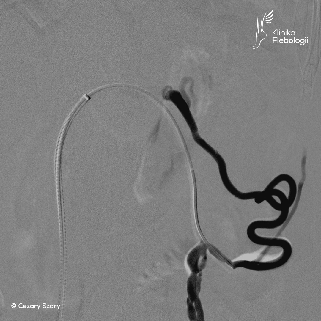 Flebografia cyfrowa. Aparat Zenition 70. Klinika Flebologii