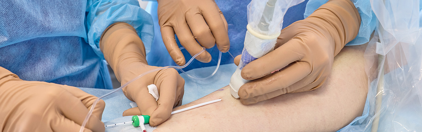 Laserowe zamykanie żylaków. ELVeS. Klinika Flebologii.