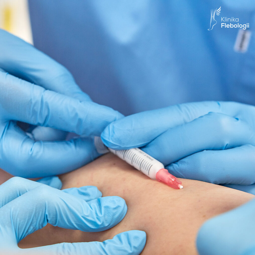 Mikroskleroterapia przy użyciu mikropiany.