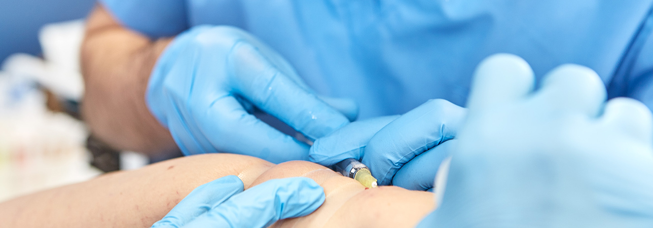 Mikroskleroterapia pajączków w Klinice Flebologii.