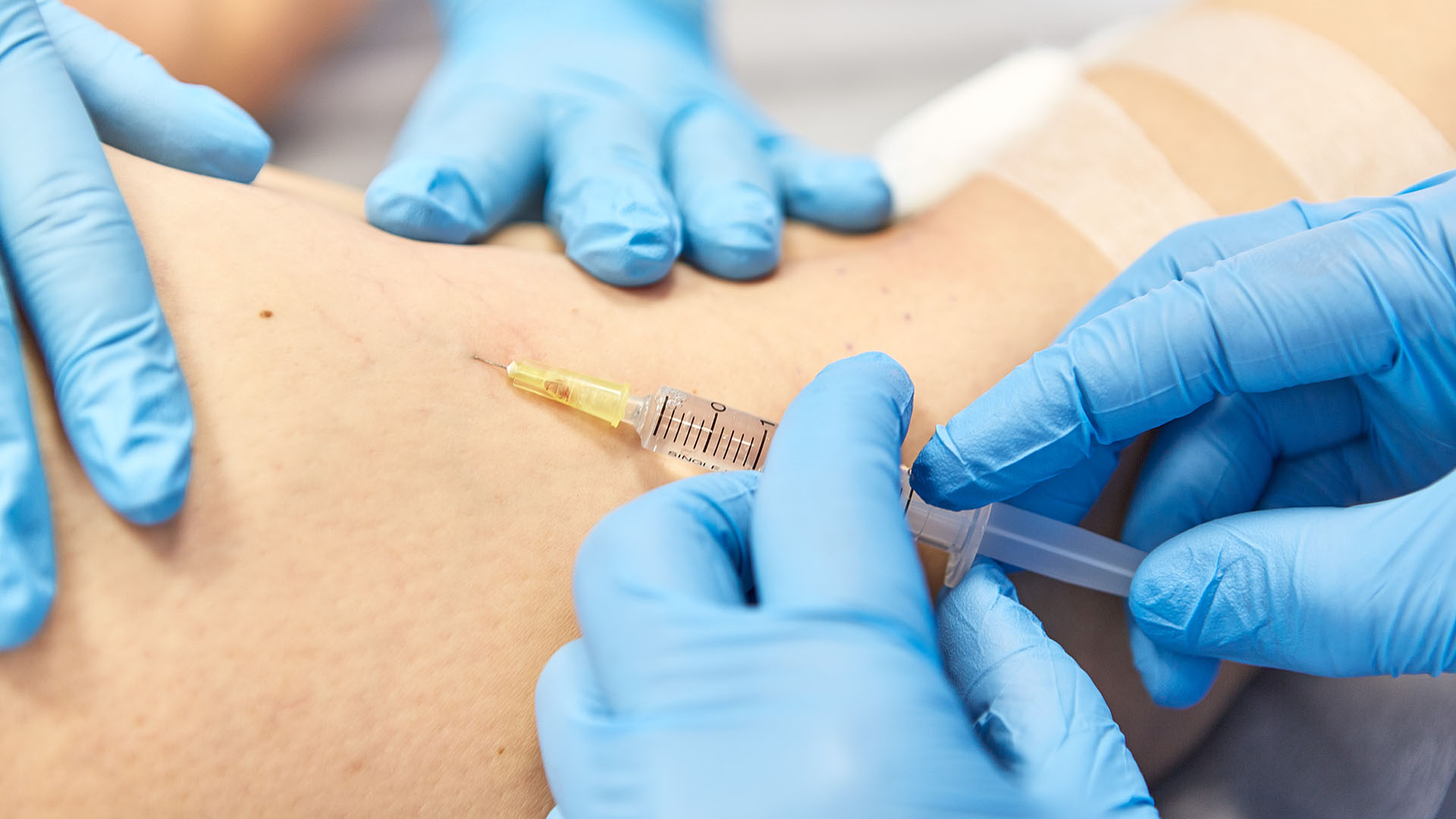 Zamykanie pajączków na udzie. Mikroskleroterapia.