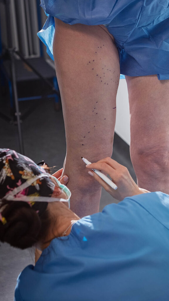 Pacjentka po safenektomii. Przed zabiegiem skleroterapii piankowej. 