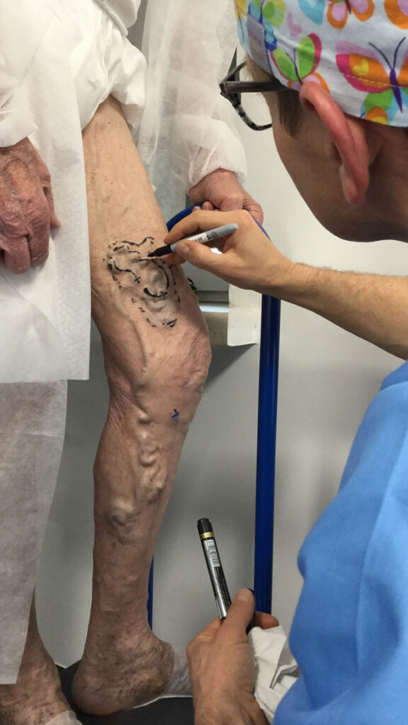 Chirurg naczyniowy mapuje żylaka przed zabiegiem safenektomii z miniflebektomią. Klinika Flebologii.