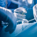 Safenektomia. Żylaki - leczenie chirurgiczne.