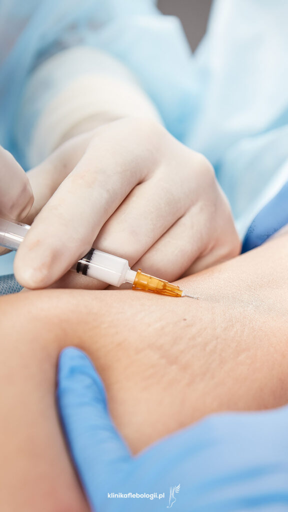 Skleroterapia piankową igłowa pod kontrolą wzroku.