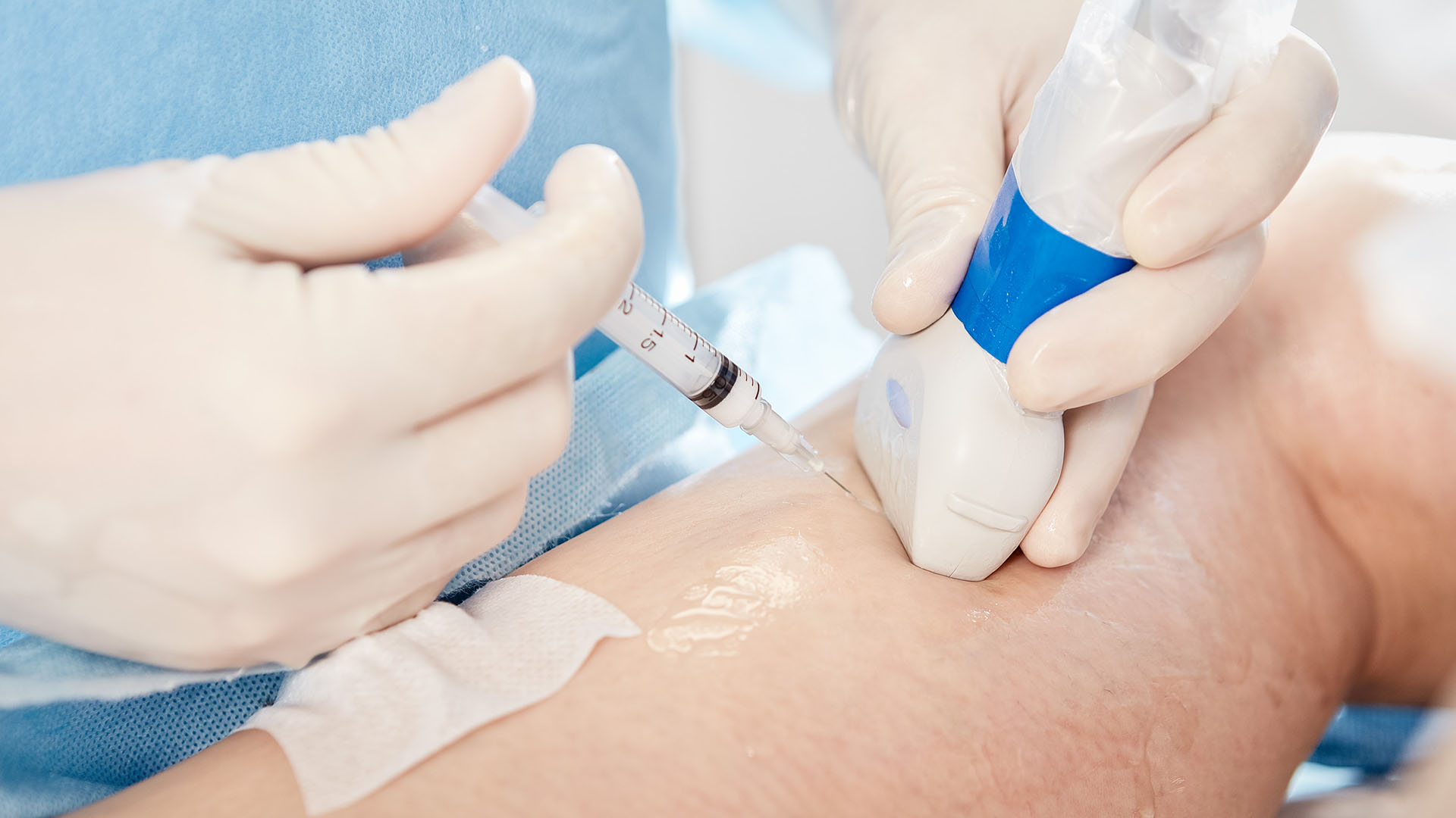 Skleroterapia piankową igłą wykonywana pod kontrolą USG