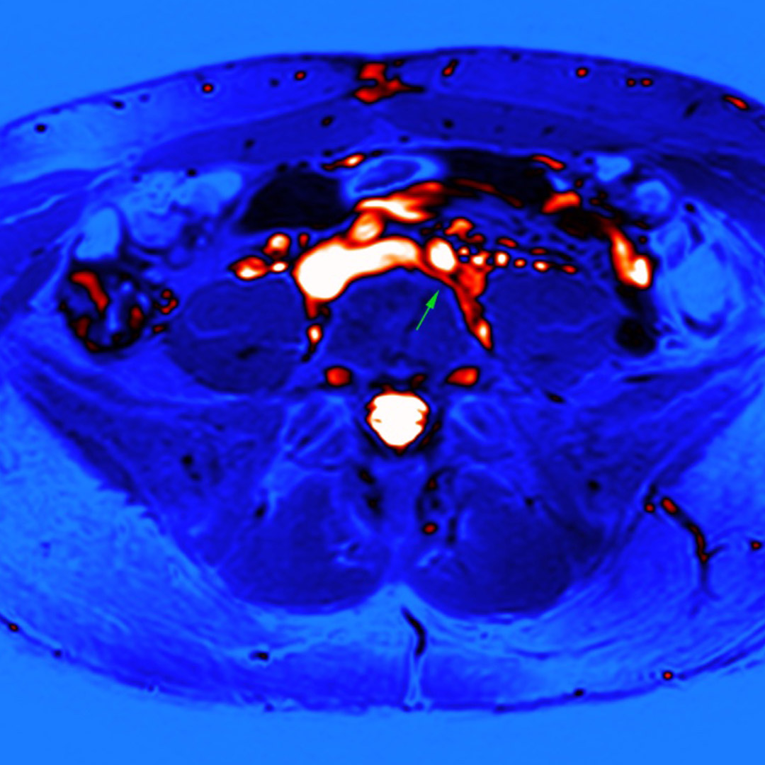 Ucisk lewej żyły biodrowej wspólnej.