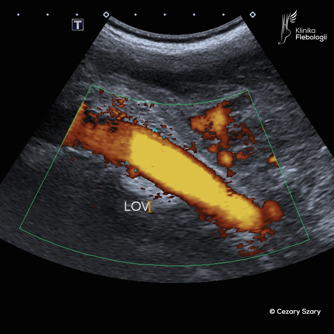 Poszerzona lewa żyła jajnikowa w badaniu USG Doppler żył. Cezary Szary